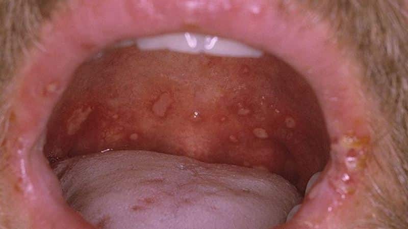 Как лечить мононуклеозную ангину у детей