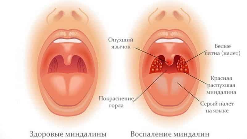 Как передается тонзиллит