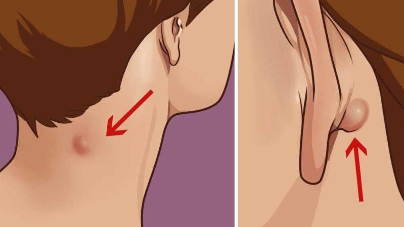 -шарик за ухом что это