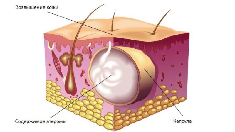 шишка под ухом на шее