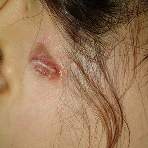 шишка на кости