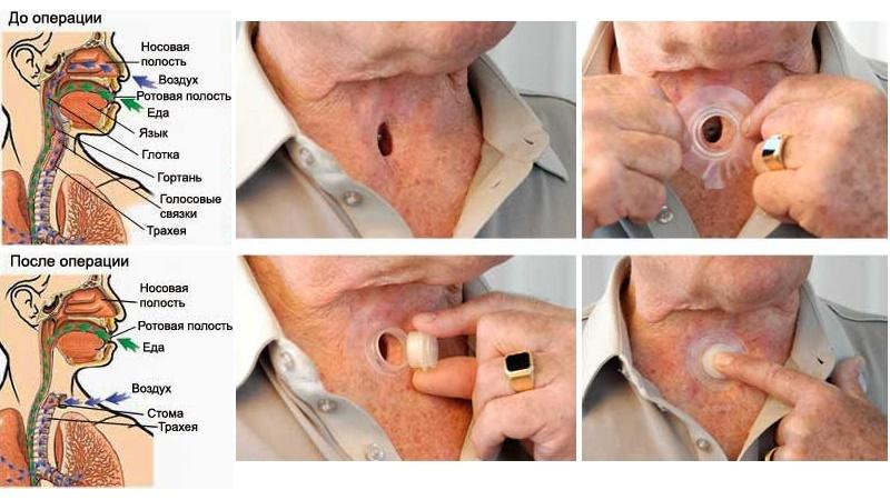 удаление гортани при злокачественной опухоли фото