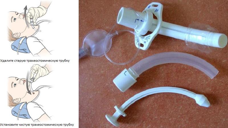 удаление гортани при злокачественной опухоли послеоперационный период