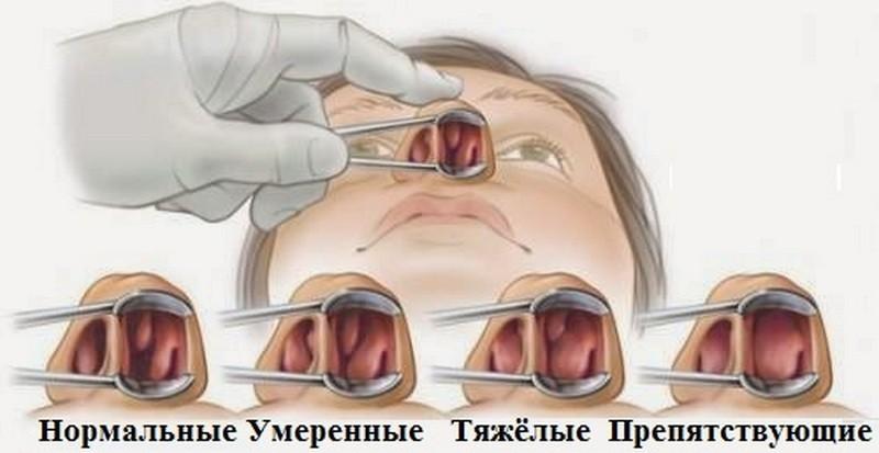 можно удалить полипы в носу лазером