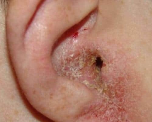 грибок в ушах симптомы лечение фото