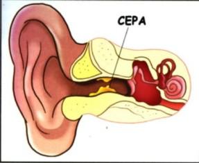 пробка в ушах