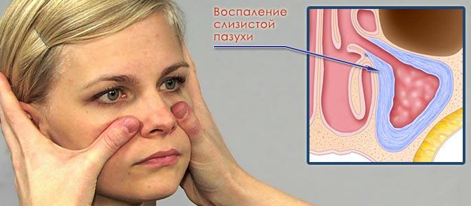 Как лечить верхнечелюстной синусит?