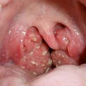 Как лечить вирусный тонзиллит