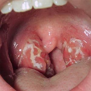 Как лечить вирусный тонзиллит