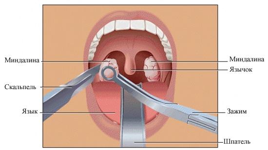 воспаление миндалин лечение в домашних условиях