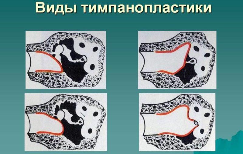 восстановление слуха