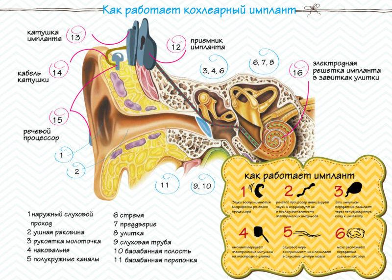 операция по восстановлению слуха