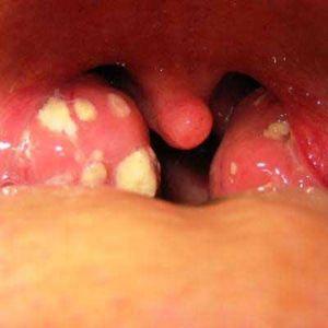 Как определить что у грудничка болит горло