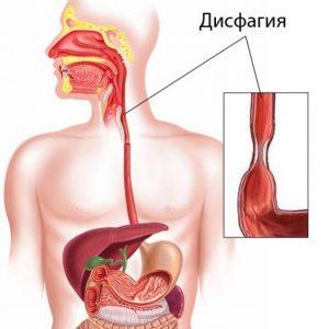 Как лечить жжение в горле
