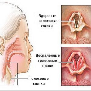 Как лечить жжение в горле