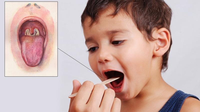 Как лечить острый тонзиллит